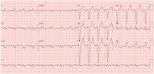 LBBB with normal postassium