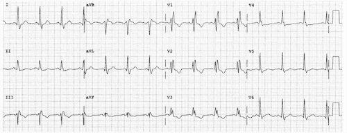 Normal RBBB