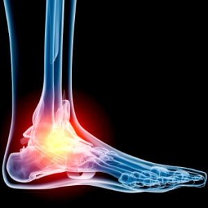Radiograph-Negative Lateral Ankle Injuries in Children: Occult Growth ...
