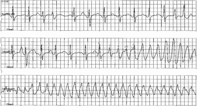Loperamide Torsades ECG