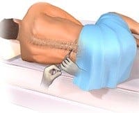 Lumbar Puncture positioning. Creative Commons License - Blausen staff