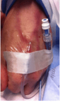 cyanide poisoning