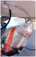 cyanide poisoning