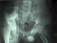 pelvic trauma fracture