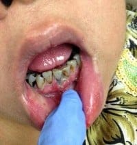 betel nut mouth