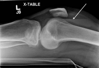 lipohemoarthrosis tibial plateau fractures