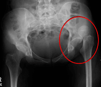 Hip dislocation xray - SplintER series