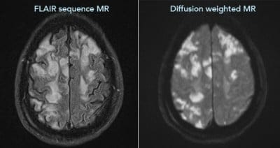 MR imaging multifocal infarcts