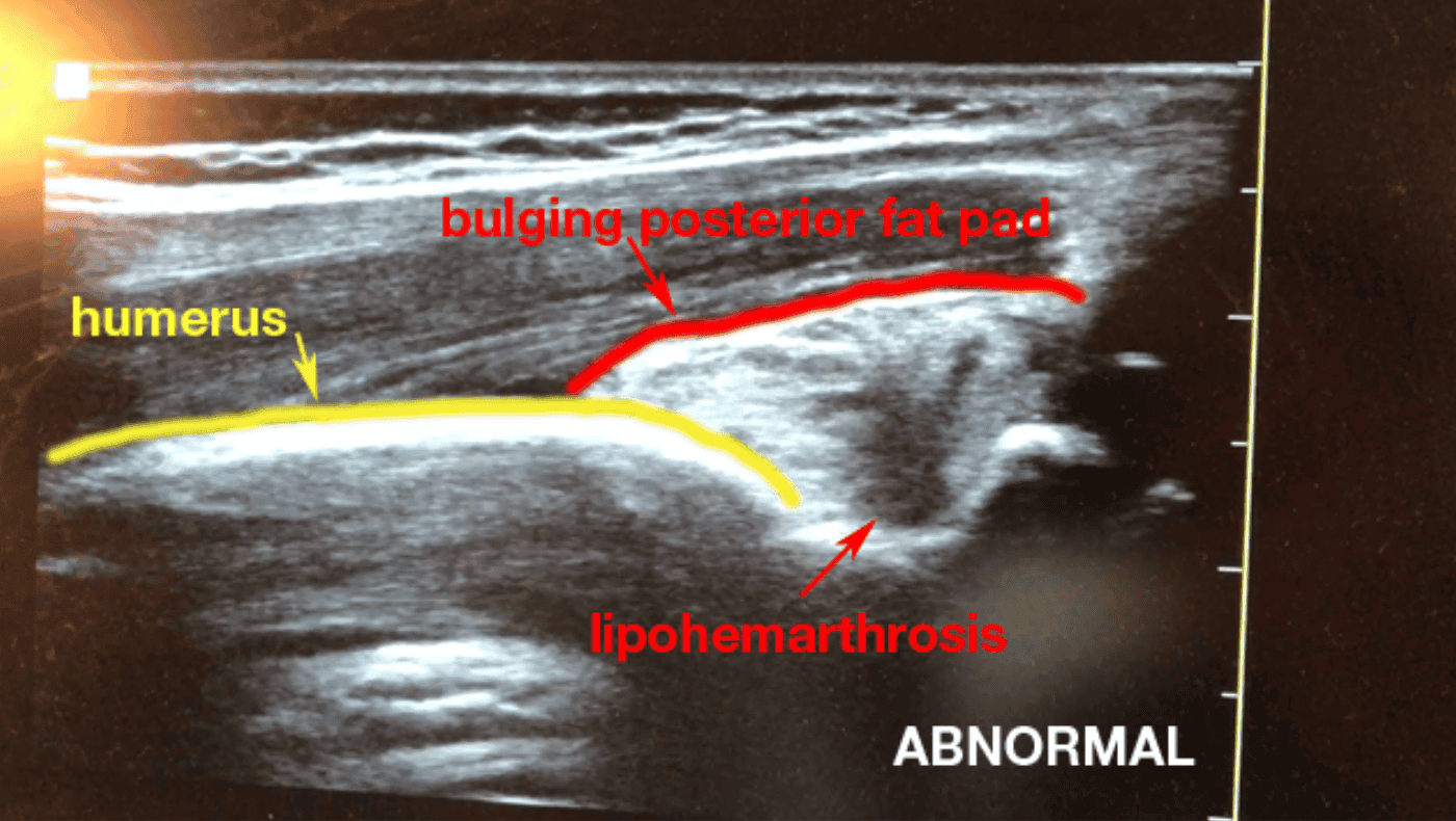 ultrasound elbow posterior fat pad