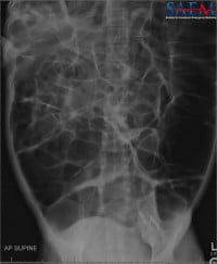 Distended Bowels Ogilvie syndrome