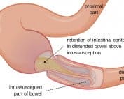 intussusception