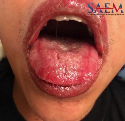 Allergic reaction 2