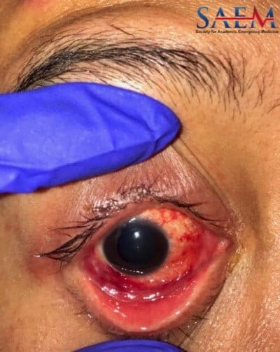 Allergic Reaction 3