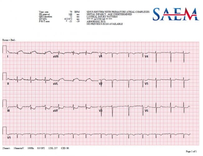 Another Heart Attack 2 ecg