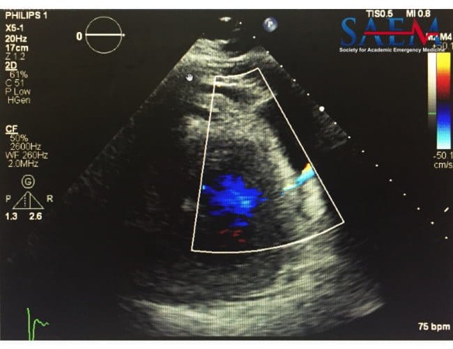 Another Heart Attack 3 ultrasound - left ventricular wall rupture