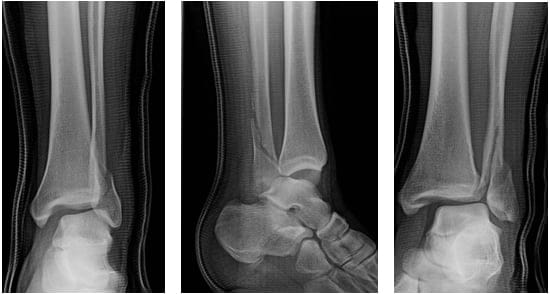 Figure 3: Plain films of a Bosworth fracture-dislocation of the ankle (image from The Orthopod 2014 case report)