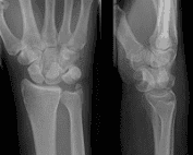 lunate dislocation xray