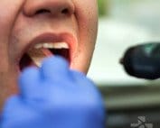 strep pharyngitis