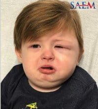 Facial swelling