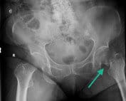 fascia iliaca nerve block hip fracture