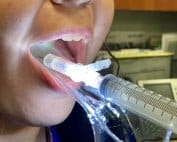 Peritonsillar abscess pelvic speculum
