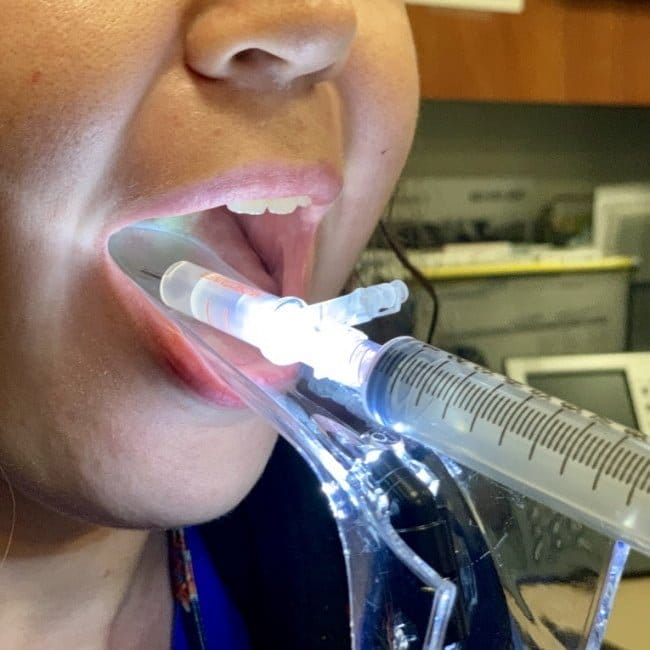 Peritonsillar abscess drainage pelvic speculum