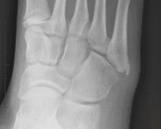iselin disease xray