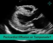 pericardial tamponade ultrasound