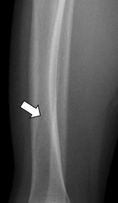 Spiral fracture of tibia