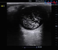 Seeing Stars asteroid hyalosis