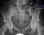 anterior inferior iliac spine