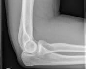 elbow-lateral-xray