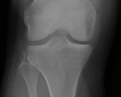 segond fracture xray
