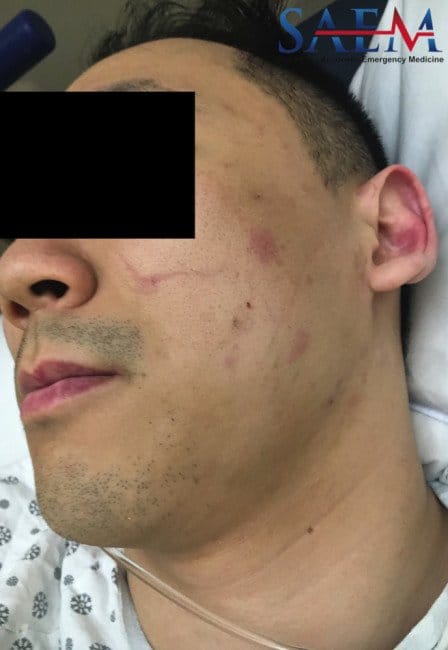Rash and Headache in AML 2