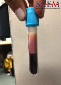 Mysterious Lab hypertriglyceridemia