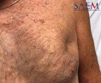 Under skin lung herniation