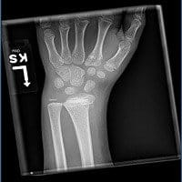 Type II Salter-Harris fracture