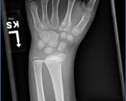 Type II Salter-Harris fracture