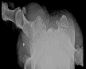 Hook of Hamate Fracture on Carpal Tunnel view