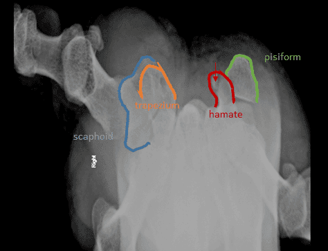 Hook of Hamate Fracture on Carpal Tunnel view