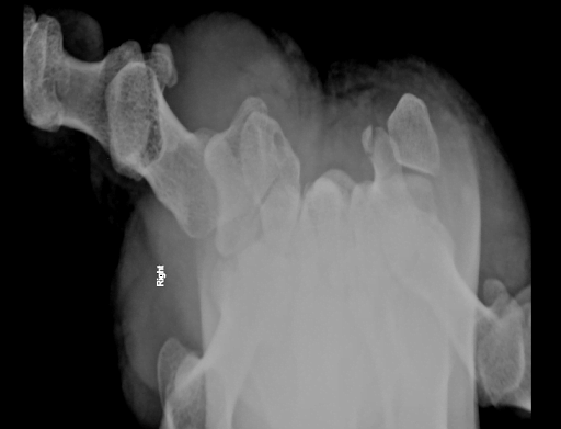 Hook of Hamate Fracture on Carpal Tunnel view