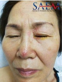 Facial Rash 1, herpes zoster ophthalmicus