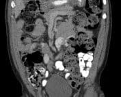 Uncommon Abdominal Pain 1, Amyand’s hernia