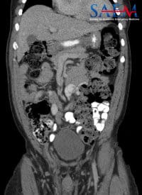 Amyand’s hernia CT