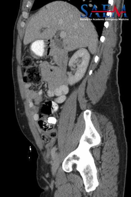Uncommon Abdominal Pain 2, Amyand’s hernia