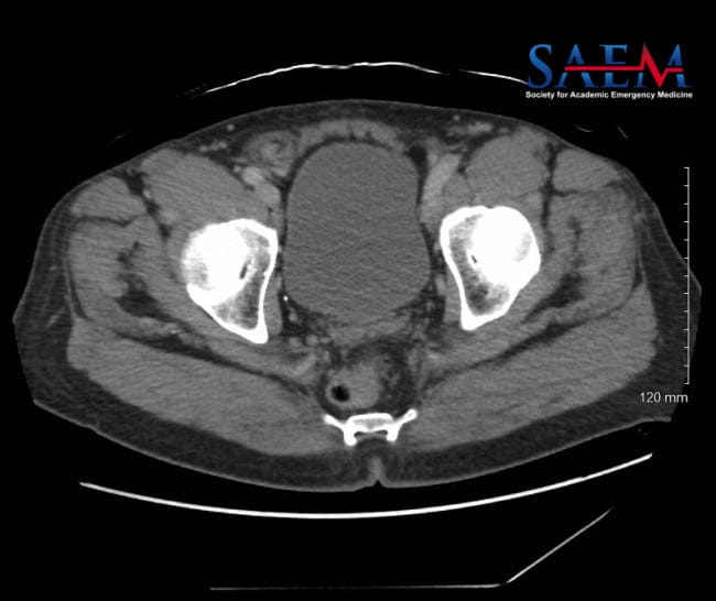 Uncommon Abdominal Pain 3, Amyand’s hernia