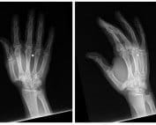 trapeziometacarpal dislocation xray