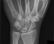 AP wrist radiograph