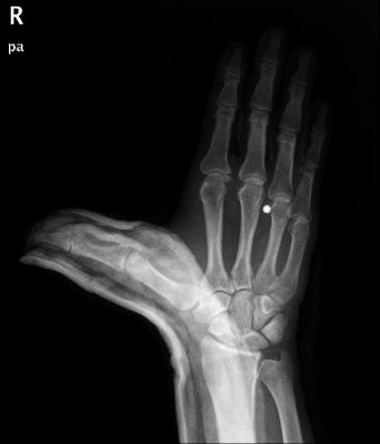 Post-reduction XR