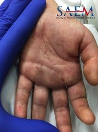 Rocky Mountain Spotted Fever tick bite hand rash